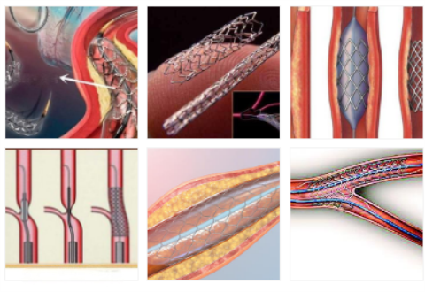 vascular stents.png